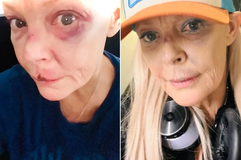 Gail Porter reveals grisly injuries after being ‘knocked over’ in London
