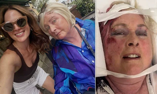 Binky Felstead dashes home from the U.S. to see her mother Jane, 74, after she suffered a fall as she shares picture of her scarred forehead