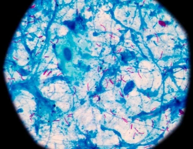 New blood test could save millions through early tuberculosis detection
