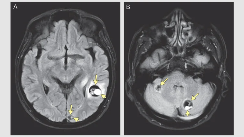 Brain Worm Culprit in Woman's Hallucinations, Incoherent Speech