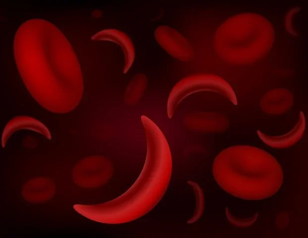 Children's Colorado helps develop national standards for sickle cell care