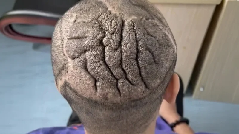 Rare medical condition causes Chinese man’s scalp to thicken and fold, resembling human brain