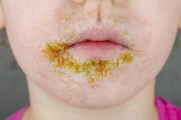 Highly contagious impetigo infection on the rise among children