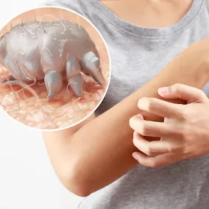 New Zealand families battle treatment-resistant scabies