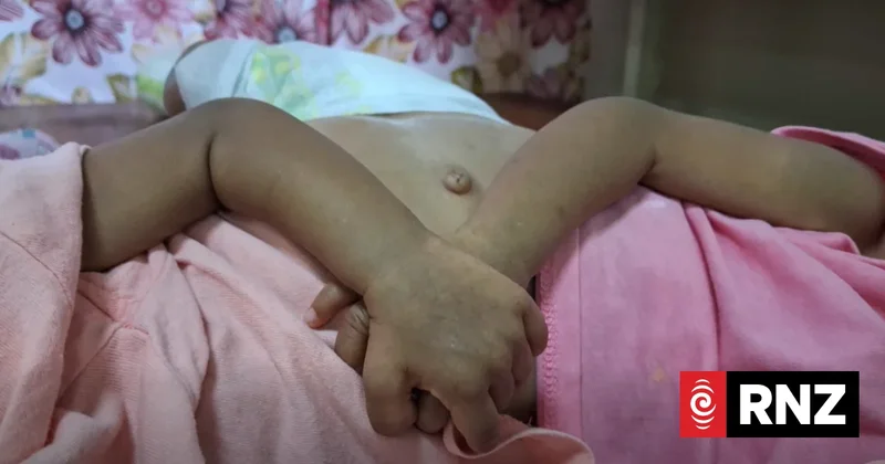 Fiji conjoined twins prepare for complex surgery in Saudi Arabia