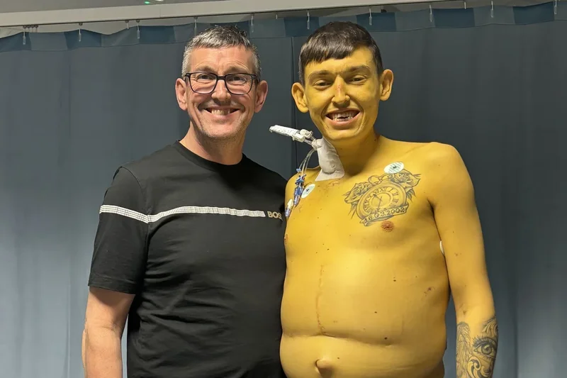 Cheshire man turns bright yellow ‘like Bart Simpson’ due to rare, life-threatening disease