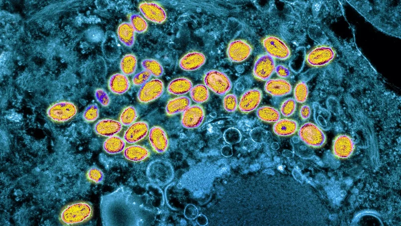 Chilean mummies prove Europeans brought smallpox to the Americas
