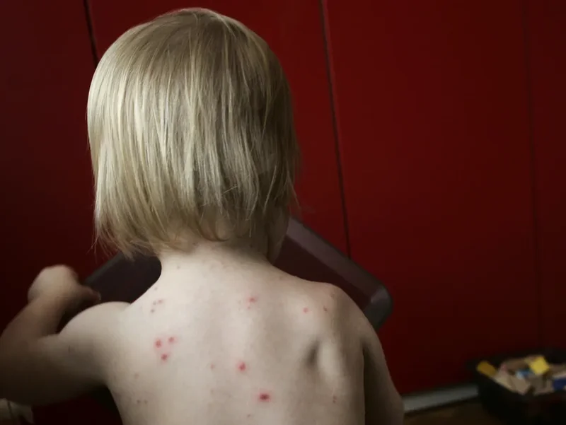 Sweden to provide free chickenpox vaccine for children