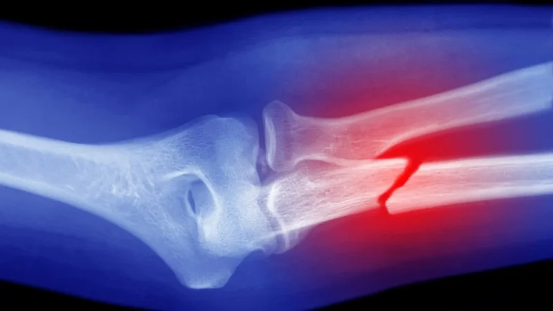 University to roll out screenings at pharmacies to uncover osteoporosis cases