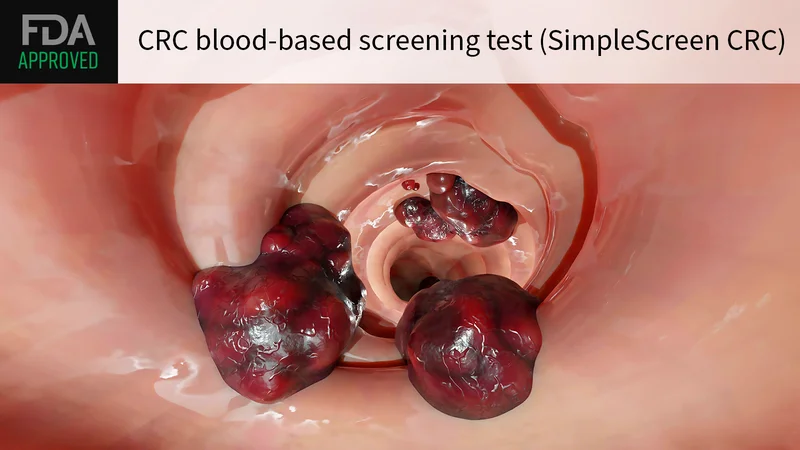 FDA Approves New Blood Test for Colon Cancer Screening