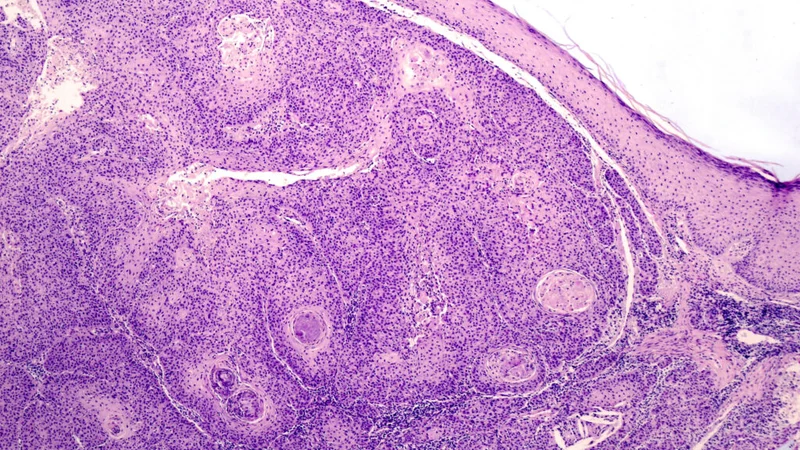 STAT+: Tracking the FDA expert review of Replimune’s melanoma treatment