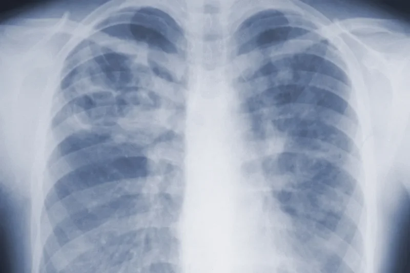 Study suggests the threat of mold-associated illnesses may be underappreciated