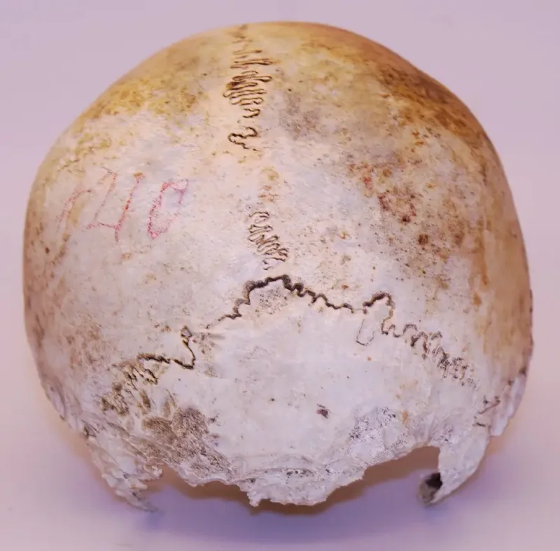 Skull found in 1975 belongs to Uxbridge, Ont. WWI veteran: police