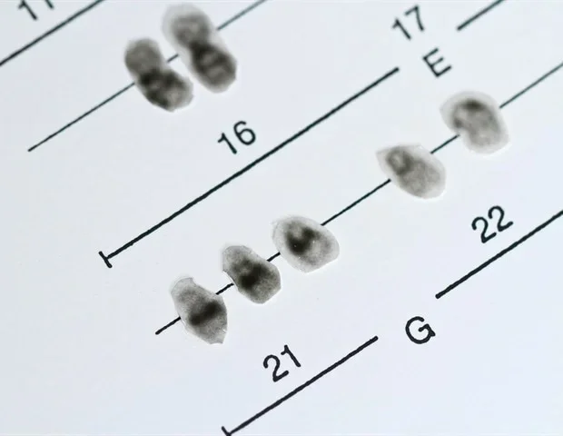 Study uncovers biological differences behind co-occurring conditions of Down syndrome