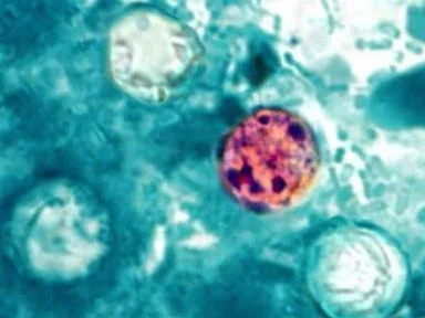 Cyclosporiasis outbreak linked to shredded iceberg lettuce expands to 9 states