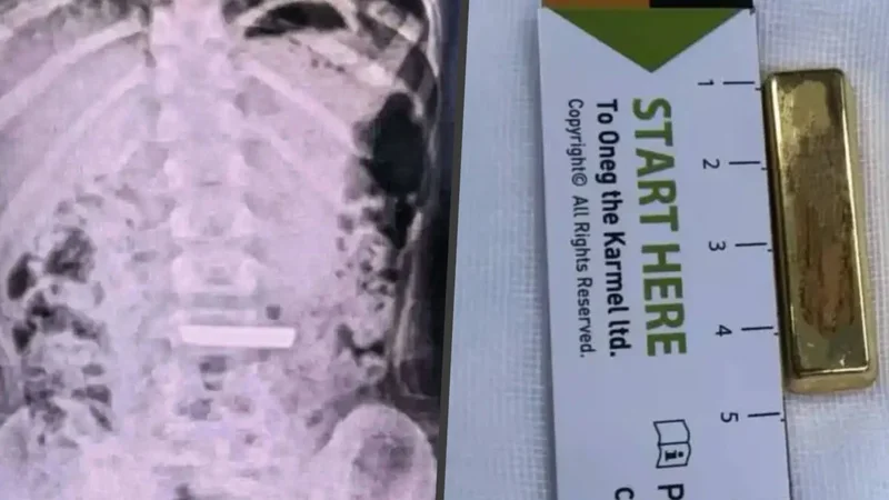 Real-life ‘gold-devouring beast’: Chinese girl, 5, hospitalised after swallowing gold bar