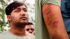 India's 'cockroach' protesters have wounds consistent with pellet-gun fire, say experts