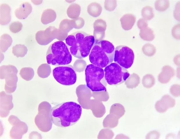 Researchers find a new genetic vulnerability in acute myeloid leukemia