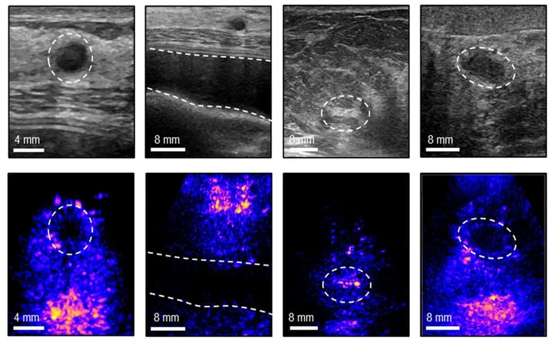 Portable breast ultrasound enables imaging between cancer screening exams