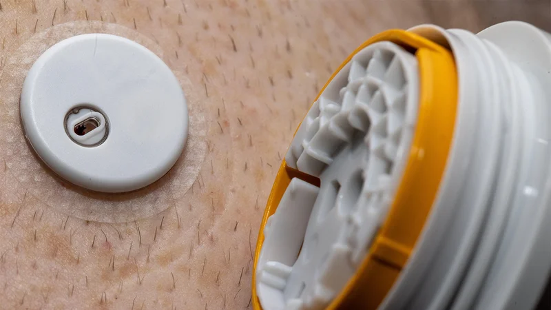 Inpatient Continuous Glucose Monitor Alerts Show Mixed Results in Trial
