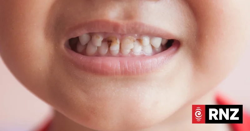 Only 57 percent of Kiwi children reach age 5 without tooth decay