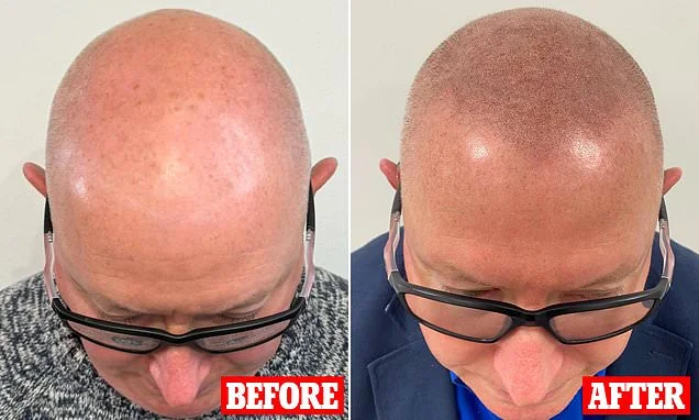 The unlikely solution for male hair loss that avoids both medication and costly transplant surgery - and it can achieve an instant transformation