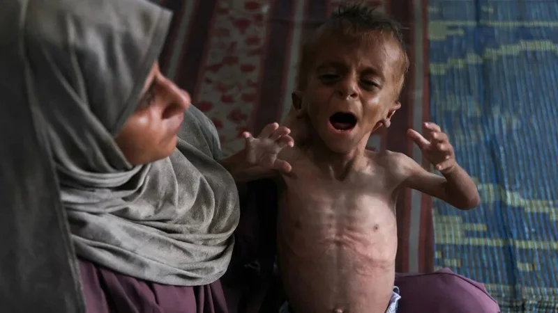 Gaza starvation: Why Israel's supporters are misrepresenting Unicef study