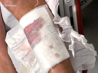 WATCH:  Connecticut man speaks out after shark attack in the Bahamas