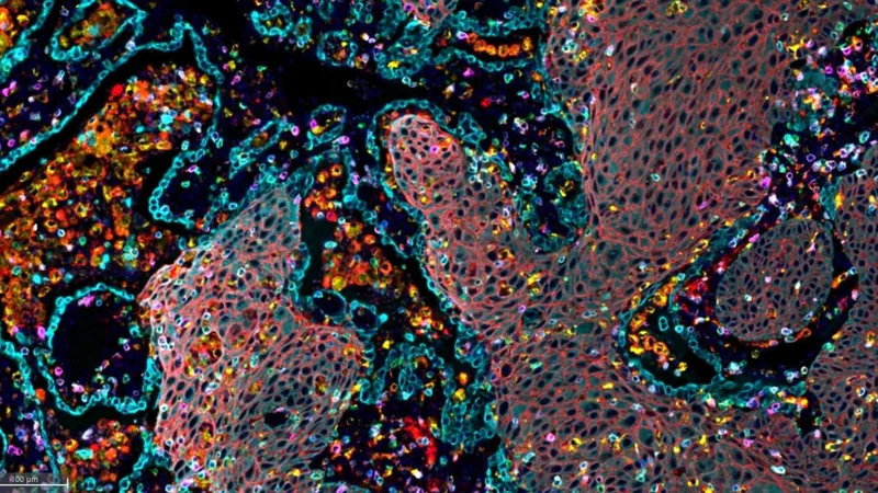 STAT+: Akeso and Summit’s lung cancer drug shows worsening tumor-progression benefit