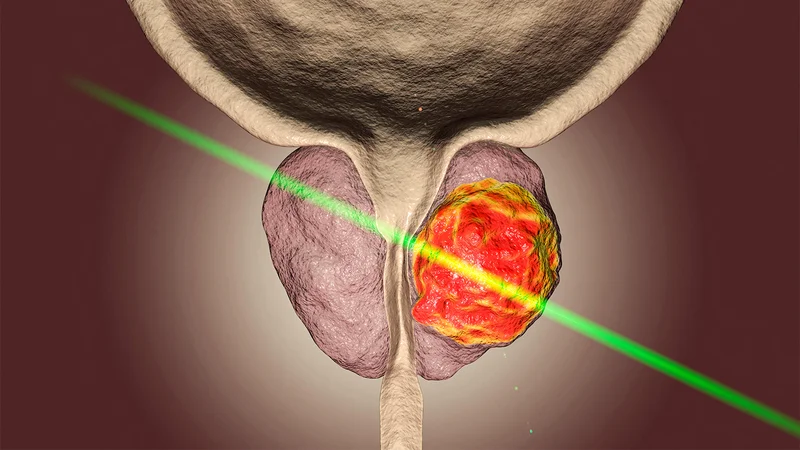 Study Questions How Prostate Cancer Focal Therapy Is Being Used