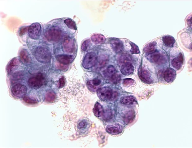 Circular eccDNA shows potential to predict early-stage LUAD recurrence