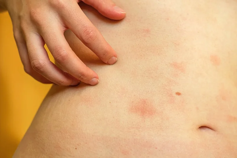 Paying attention to your body may change how an acute skin inflammation unfolds