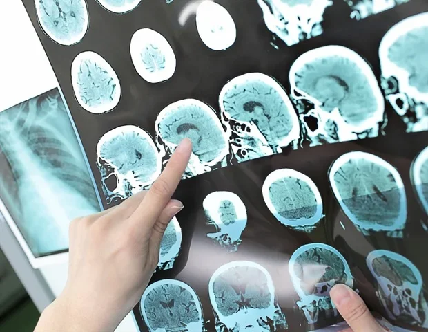 Physical activity linked to lower stroke and death risk in adults with atrial fibrillation