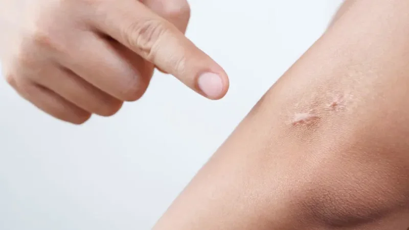 Can you make scars fade? Doctors explain why they form and what works – from silicone sheets to Vitamin E