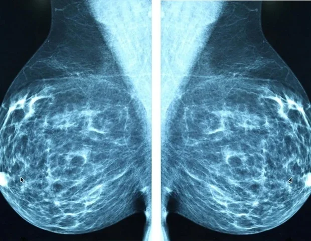 Digital care app improves quality of life for breast cancer patients