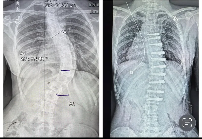 Alberta teen’s family sues government after nearly $200K out-of-country surgical bill