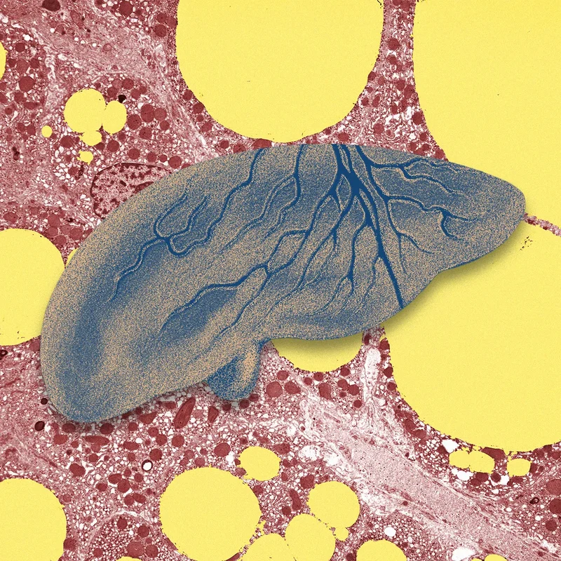 There’s a Fatty Liver Epidemic. AI Could Help Get Ahead of It