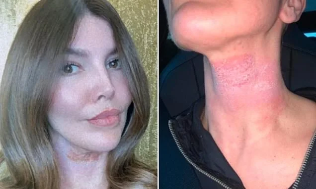 My doctor dismissed my burning skin as severe eczema. I was in agony for months. Then I discovered what was really happening. If you've ever used steroid creams, this is what you need to know