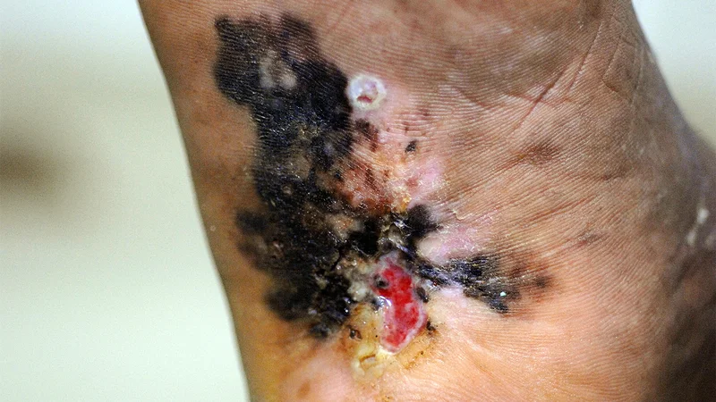 FDA Finally OKs Twice-Rejected Melanoma Drug