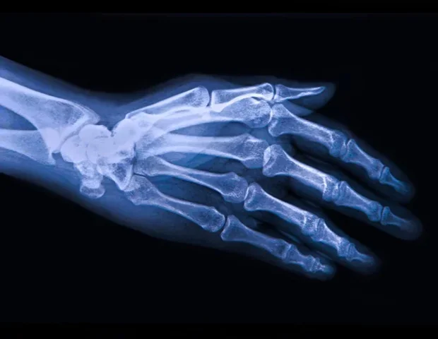 Combining genetics and AI to discover new osteoarthritis drugs