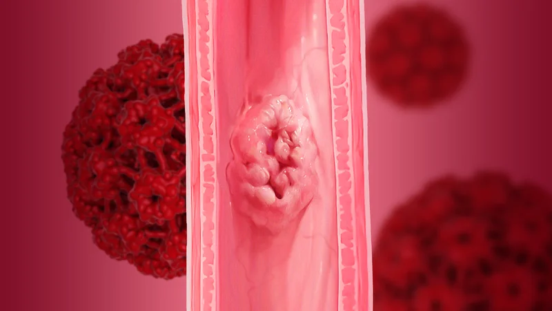 HPV Infection and Esophageal Cancer