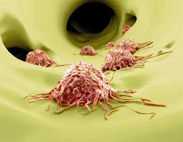 AI-based methods help uncover hidden roots of tumor metastasis